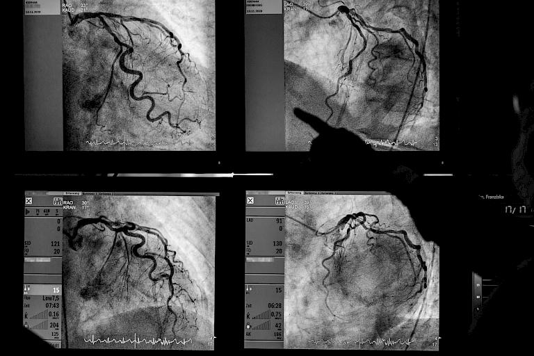 Bild eines Herzkatheters und Bild von Röntgenaufnahmen eines Herzens